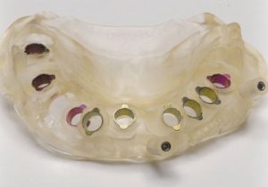 3d printed surgical guide for teeth