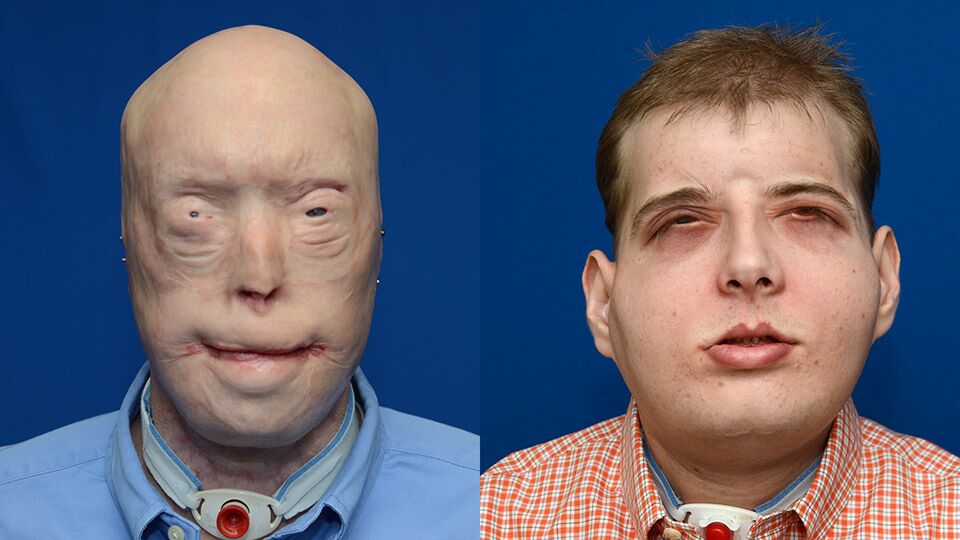 world’s most expensive and complex face transplant : Before-After