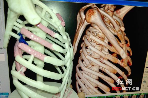A 3D printed rib-cage model was used to perform a complex surgery