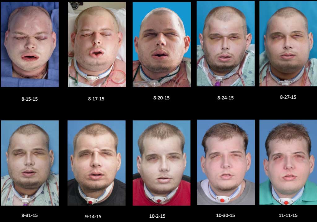 world’s most expensive and complex face transplant : Patient progress