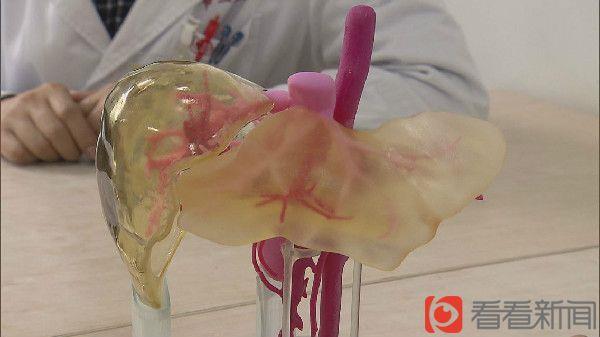 First successful liver transplant with the assistance of 3D printed model