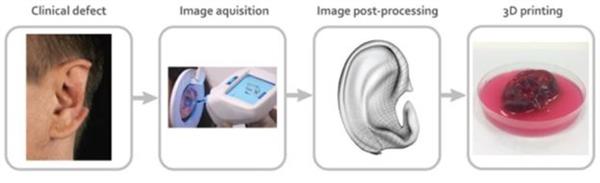 Researchers 3D print cartilage that can be used for ear and nose transplants