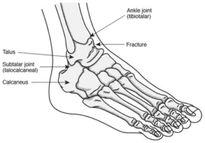 TalusFracture