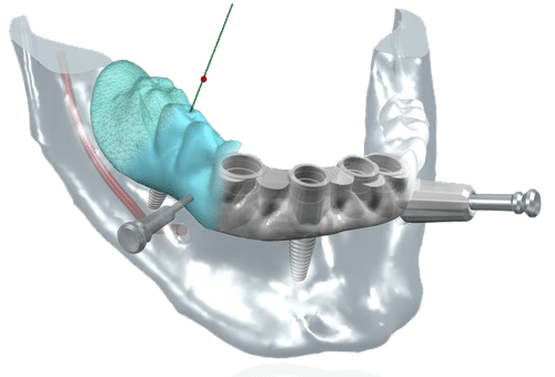 surgicalguide